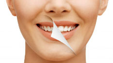 Teeth Whitening in Vasant Kunj